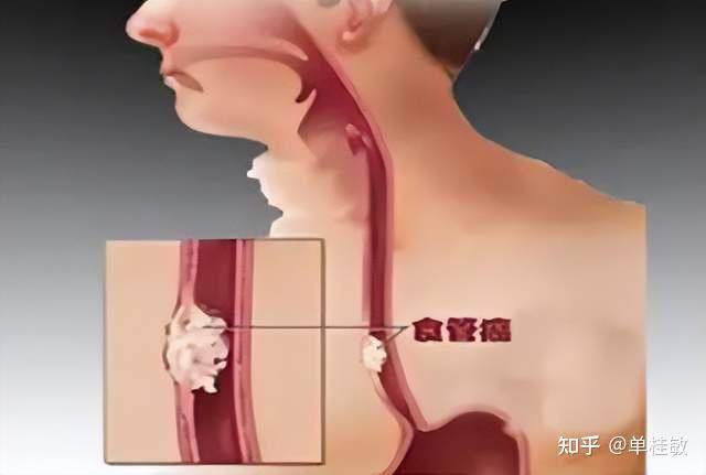 食道癌最新研究进展与先进治疗策略概述